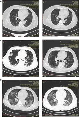 Characteristics and Outcomes of 35 Breast Cancer Patients Infected With COVID-19